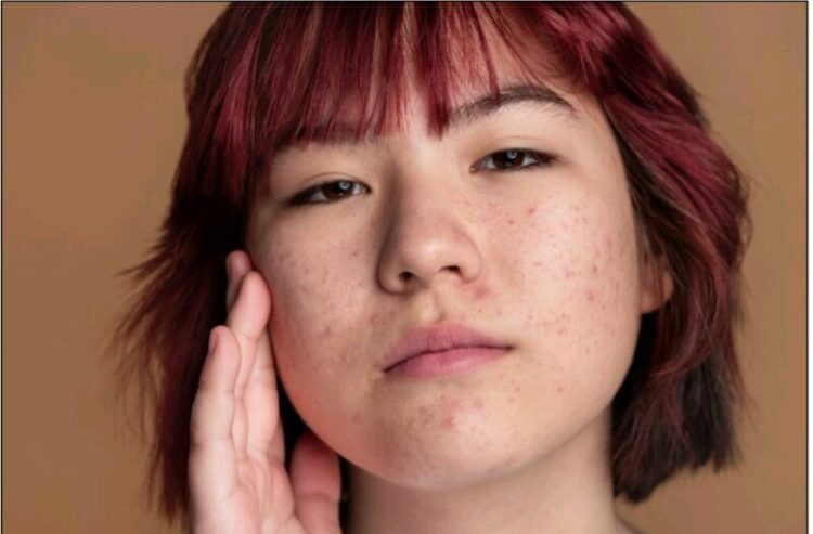 Yuk Basmi Jerawat dengan Nacific Acne Cica Plus, Dapatkan Segera di Blibli!
